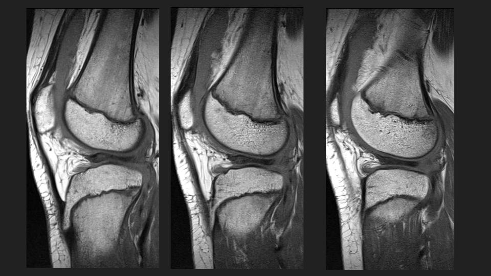 Figure 4 for case discoid lateral meniscus ( RID2771 )